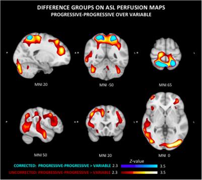 Regional Cerebral Perfusion and Cerebrovascular Reactivity in Elderly Controls With Subtle Cognitive Deficits